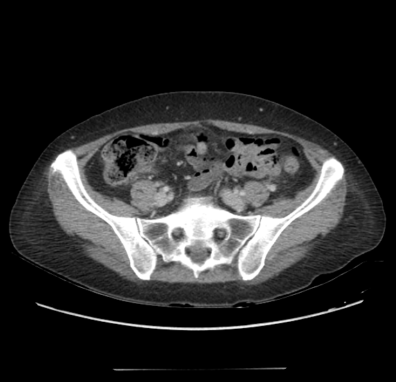 Acute pancreatitis - Balthazar E - post ERCP (Radiopaedia 27562-27772 Axial C+ portal venous phase 56).png