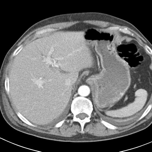 File:Acute pancreatitis and walled-off necrosis (Radiopaedia 29888-30403 Axial C+ portal venous phase 4).jpg