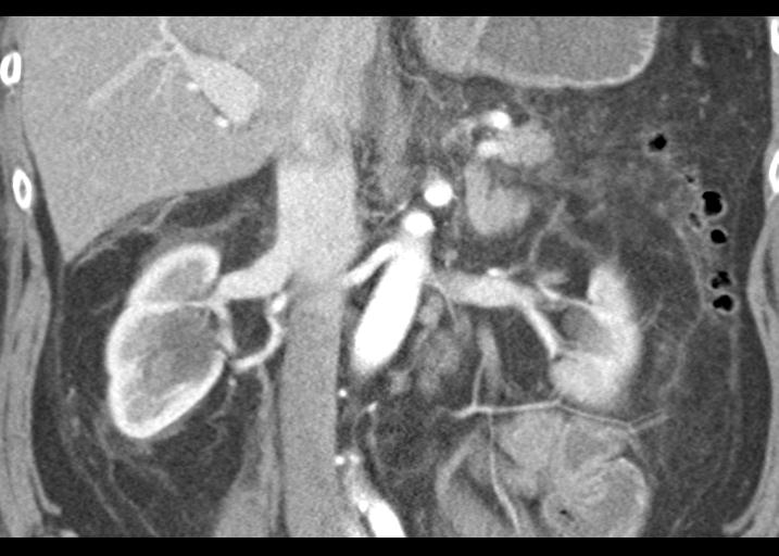 Acute pancreatitis and walled-off necrosis (Radiopaedia 29888-30403 Coronal C+ portal venous phase 32).jpg