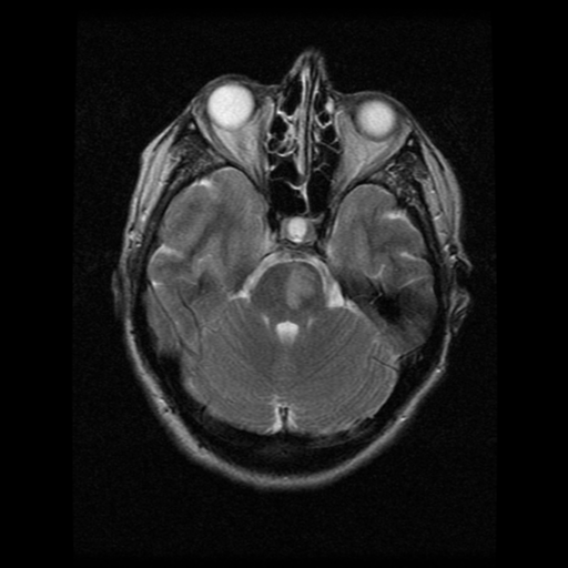 File:Acute pontine infarct from vertebral artery dissection (Radiopaedia 34111-35370 Axial T2 6).png