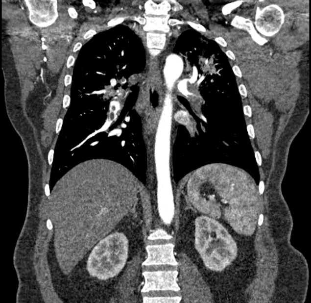 Acute pulmonary embolism with pulmonary infarcts (Radiopaedia 77688-89908 Coronal C+ CTPA 62).jpg