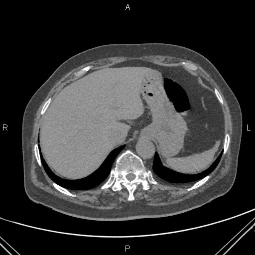 Acute renal artery occlusion (Radiopaedia 86586-102682 Axial non-contrast 10).jpg