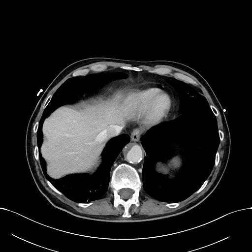 File:Acute renal infarction (Radiopaedia 59375-66736 Axial C+ portal venous phase 9).jpg