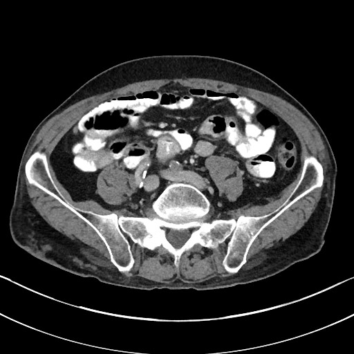Acute renal infarction - rim capsular enhancement (Radiopaedia 59833-67270 Axial C+ portal venous phase 66).jpg