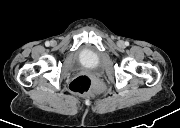 Acute small bowel (ileal) volvulus (Radiopaedia 71740-82139 Axial C+ portal venous phase 193).jpg