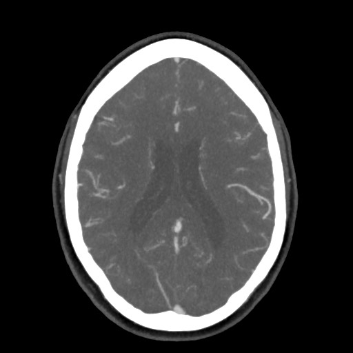 Acute subarachnoid hemorrhage and accessory anterior cerebral artery (Radiopaedia 69231-79009 D 43).jpg
