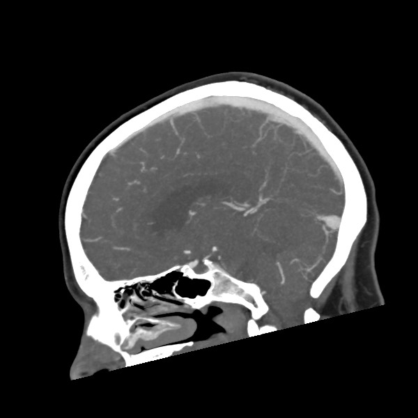 Acute subarachnoid hemorrhage and accessory anterior cerebral artery (Radiopaedia 69231-79009 Sagittal C+ arterial phase 35).jpg