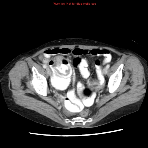 File:Adenocarcinoma of the colon (Radiopaedia 8191-9039 Axial liver window 65).jpg