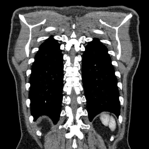 Adenocarcinoma of the lung (Radiopaedia 59871-67325 Coronal C+ arterial phase 62).jpg