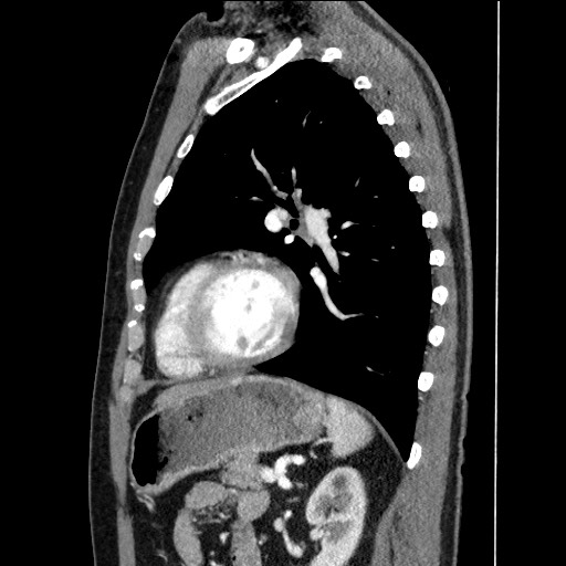 Adenocarcinoma of the lung (Radiopaedia 59871-67325 Sagittal C+ arterial phase 70).jpg
