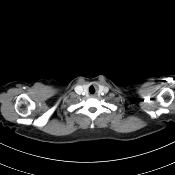 Adenocystic carcinoma of the trachea (Radiopaedia 47677-52525 Axial C+ arterial phase 27).jpg