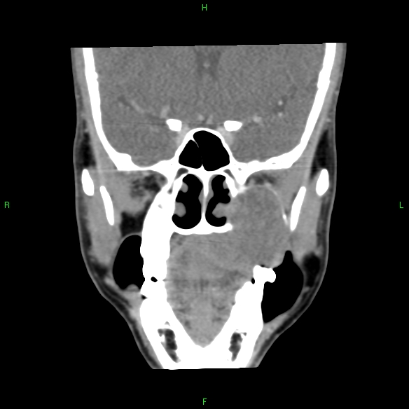 File:Adenoid cystic carcinoma of hard palate (Radiopaedia 26137-26273 Coronal liver window 13).jpg