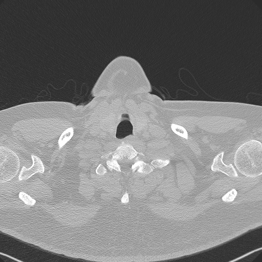 Adenoid cystic carcinoma of the trachea (Radiopaedia 49042-54137 Axial lung window 1).jpg