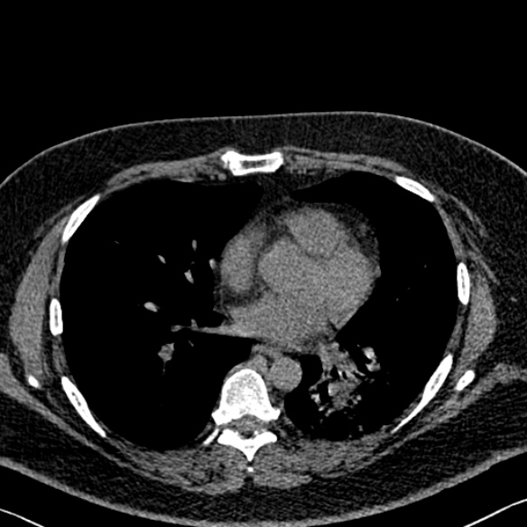 Adenoid cystic carcinoma of the trachea (Radiopaedia 49042-54137 Axial non-contrast 202).jpg