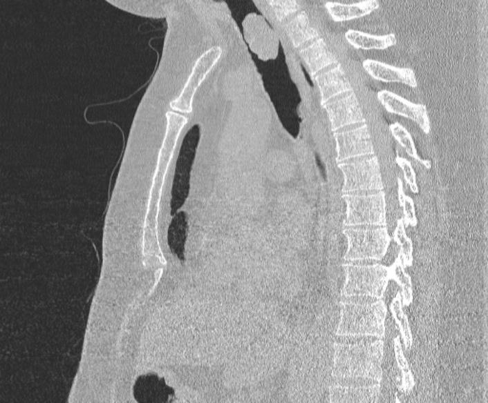 Adenoid cystic carcinoma of the trachea (Radiopaedia 49042-54137 Sagittal lung window 239).jpg