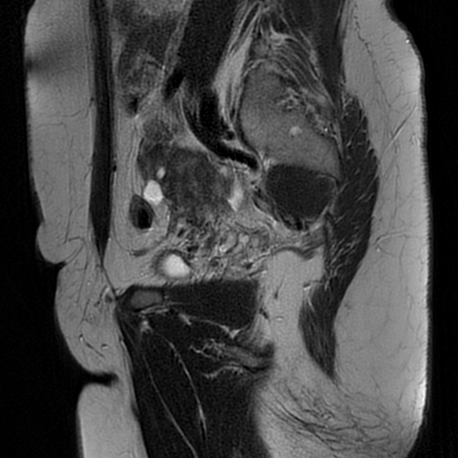 File:Adenomyosis-scar endometriosis (Radiopaedia 65863-75022 Sagittal T2 21).jpg