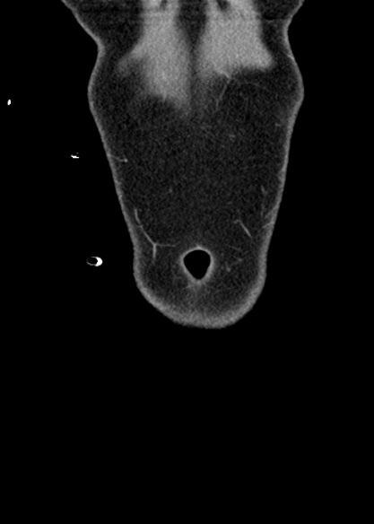 Adhesional small bowel obstruction (Radiopaedia 48397-53305 Coronal C+ portal venous phase 19).jpg