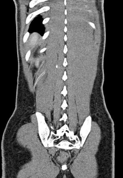 Adhesional small bowel obstruction (Radiopaedia 52107-57980 Coronal C+ portal venous phase 71).jpg