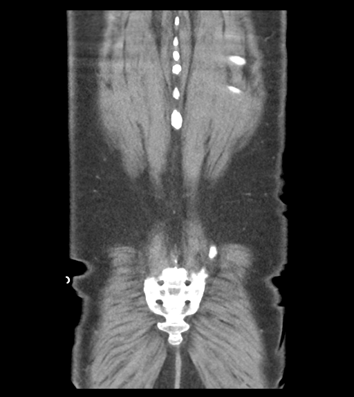 Adhesions within abdominal wall hernia (Radiopaedia 58283-65394 Coronal C+ portal venous phase 63).png