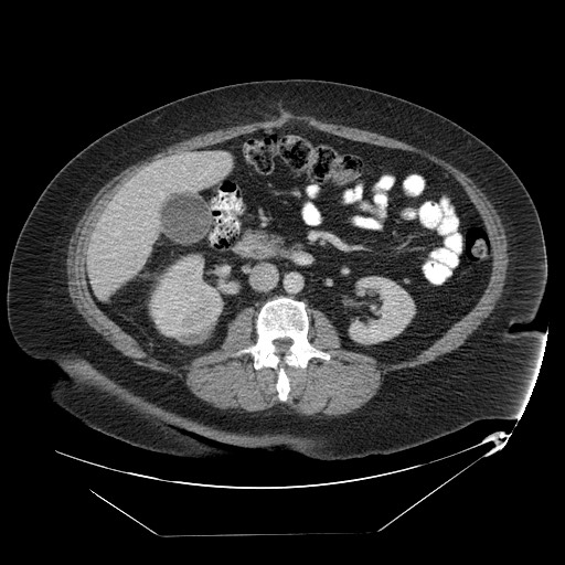 Adrenal angiosarcoma (Radiopaedia 81081-94671 Axial C+ portal venous phase 38).jpg