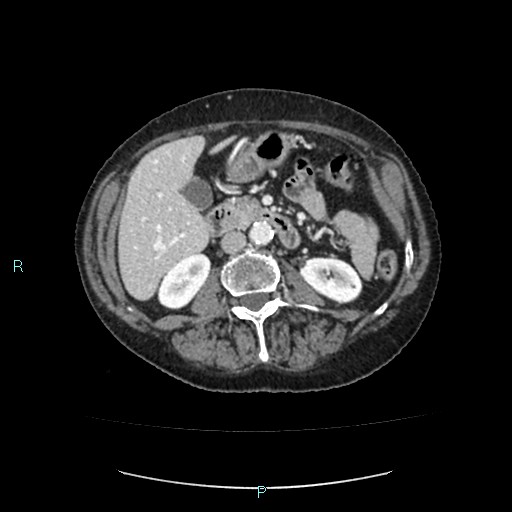 File:Adrenal collision tumor (ACT) (Radiopaedia 48462-53379 Axial C+ portal venous phase 27).jpg