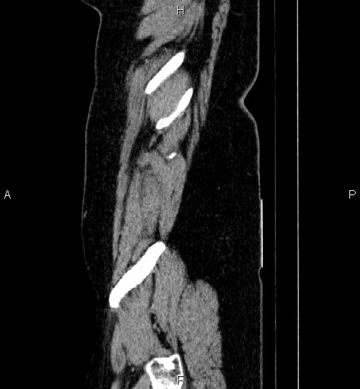 Adrenal cortical carcinoma (Radiopaedia 84882-100379 Sagittal C+ portal venous phase 83).jpg