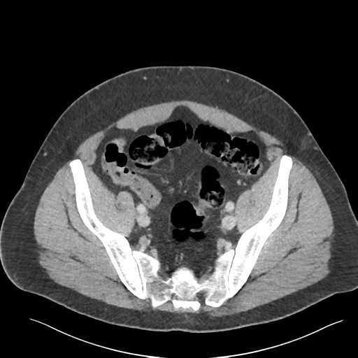 Adrenal cyst (Radiopaedia 45625-49777 Axial C+ portal venous phase 82).png
