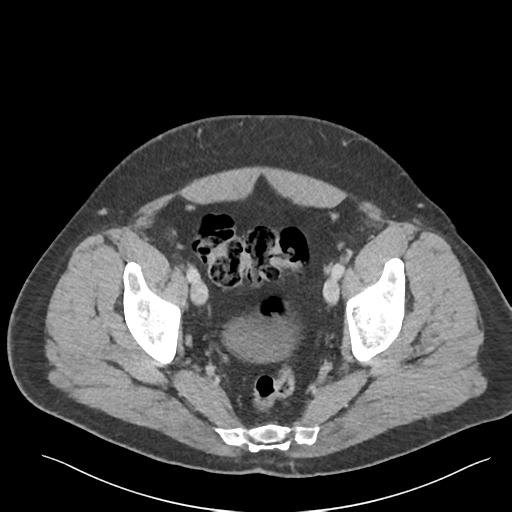Adrenal cyst (Radiopaedia 45625-49777 Axial C+ portal venous phase 88).png
