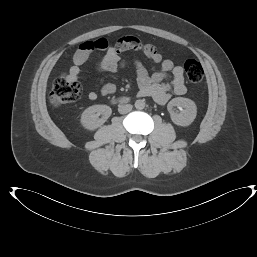 File:Adrenal cyst (Radiopaedia 45625-49778 Axial non-contrast 64).png
