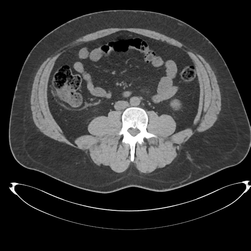Adrenal cyst (Radiopaedia 45625-49778 Axial non-contrast 73).png