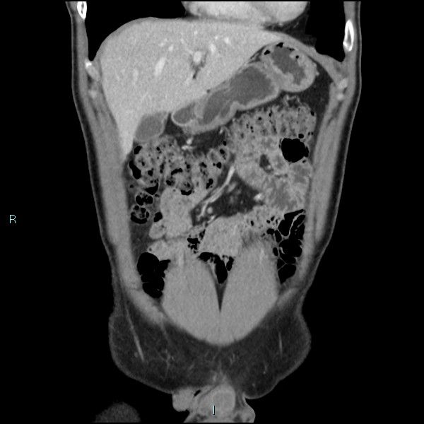 Adrenal cystic lymphangioma (Radiopaedia 83161-97534 Coronal C+ portal venous phase 20).jpg