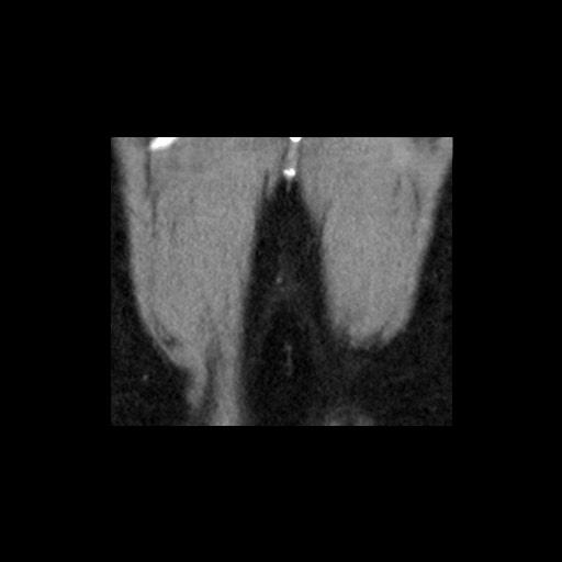 Adrenal gland trauma (Radiopaedia 81351-95079 Coronal non-contrast 86).jpg
