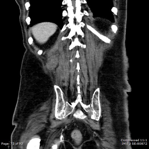 Adrenal metastasis (Radiopaedia 78425-91079 Sagittal C+ portal venous phase 60).jpg