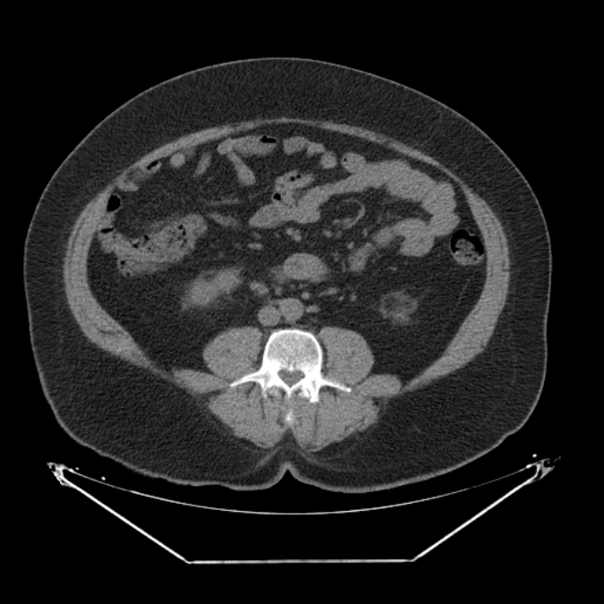 Adrenal myelolipoma (Radiopaedia 26278-26407 Axial non-contrast 40).jpg