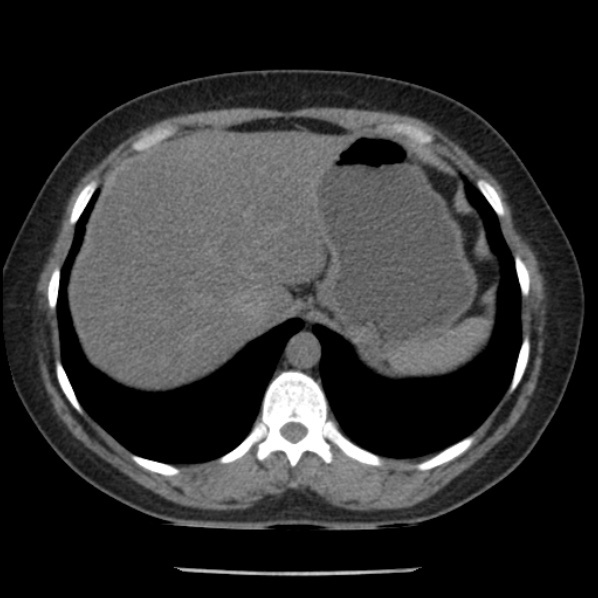 File:Adrenal myelolipoma (Radiopaedia 43401-46759 Axial non-contrast 14).jpg