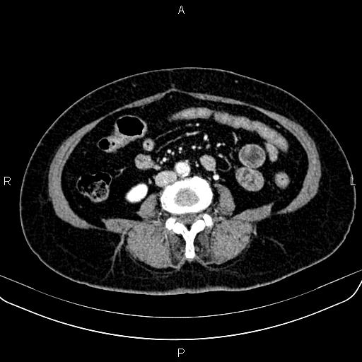 Adrenal myelolipoma (Radiopaedia 82742-96986 Axial renal cortical phase 103).jpg