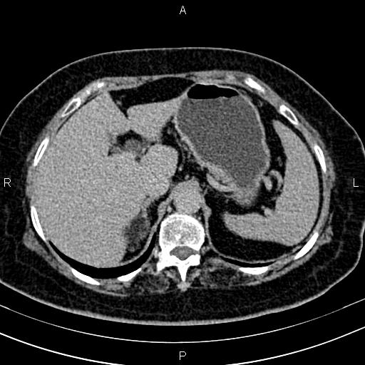 Adrenal myelolipoma (Radiopaedia 82742-96986 Axial renal excretory phase 30).jpg