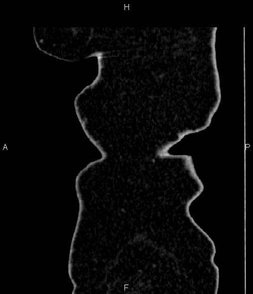 File:Adrenal myelolipoma (Radiopaedia 82742-96986 Sagittal renal cortical phase 108).jpg