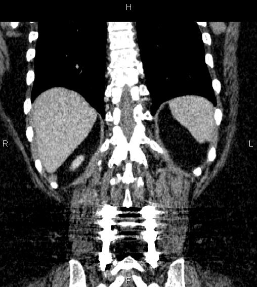Adrenal myelolipoma (Radiopaedia 84319-99617 Coronal renal cortical phase 64).jpg