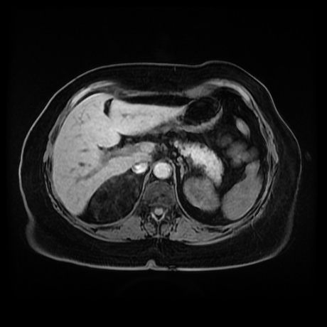 Adrenal myelolipoma - MRI (Radiopaedia 83249-97646 Axial T1 fat sat 25).jpg