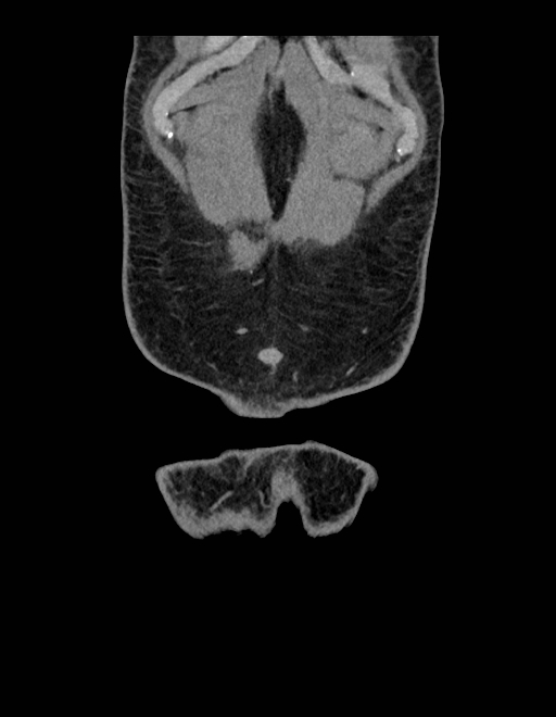 Adrenal myelolipoma - bilateral (Radiopaedia 74805-85810 Coronal C+ portal venous phase 248).jpg