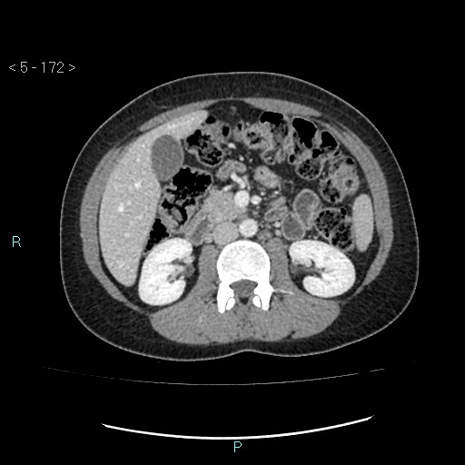 Adult transient intestinal intussusception (Radiopaedia 34853-36310 Axial C+ portal venous phase 26).jpg
