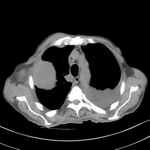 Advanced metastatic lung cancer (Radiopaedia 48910-53954 Axial non-contrast 19).png