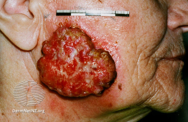 File:Advanced squamous cell carcinoma (DermNet NZ scc-103).jpg