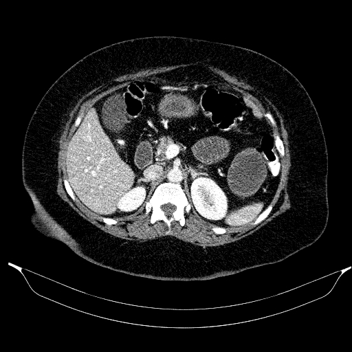 File:Afferent loop syndrome - secondary to incarcerated trocar site hernia (Radiopaedia 82959-97305 Axial C+ portal venous phase 80).jpg