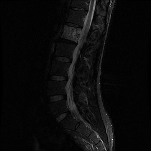 File:Aggressive vertebral hemangioma with pathological fracture (Radiopaedia 69528-79411 Sagittal STIR 6).jpg