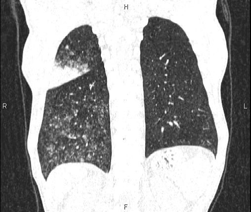 Air bronchogram in pneumonia (Radiopaedia 85719-101512 Coronal lung window 47).jpg