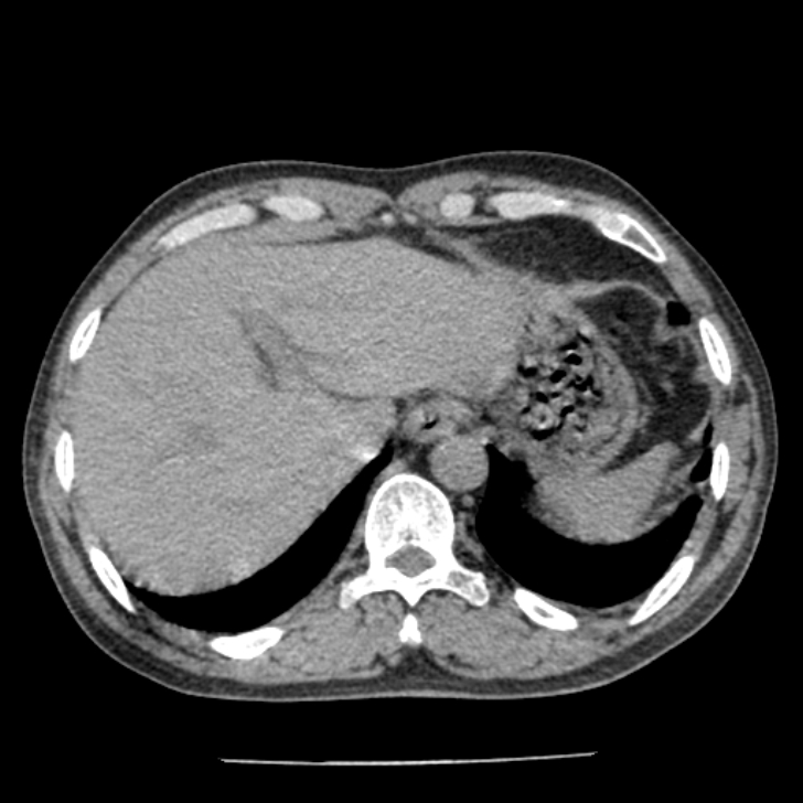Airway foreign body in adult (Radiopaedia 85907-101779 Axial liver window 177).jpg