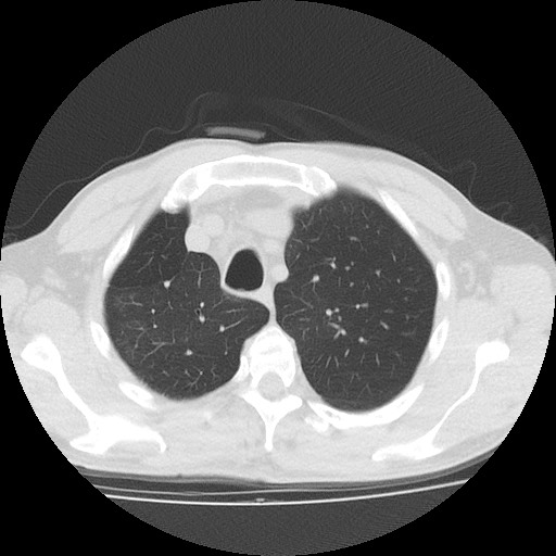 File:Allergic bronchopulmonary aspergillosis (ABPA) (Radiopaedia 60594-68313 Axial lung window 11).jpg