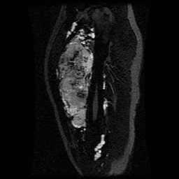 Alveolar soft part sarcoma (Radiopaedia 64501-73678 D 87).jpg